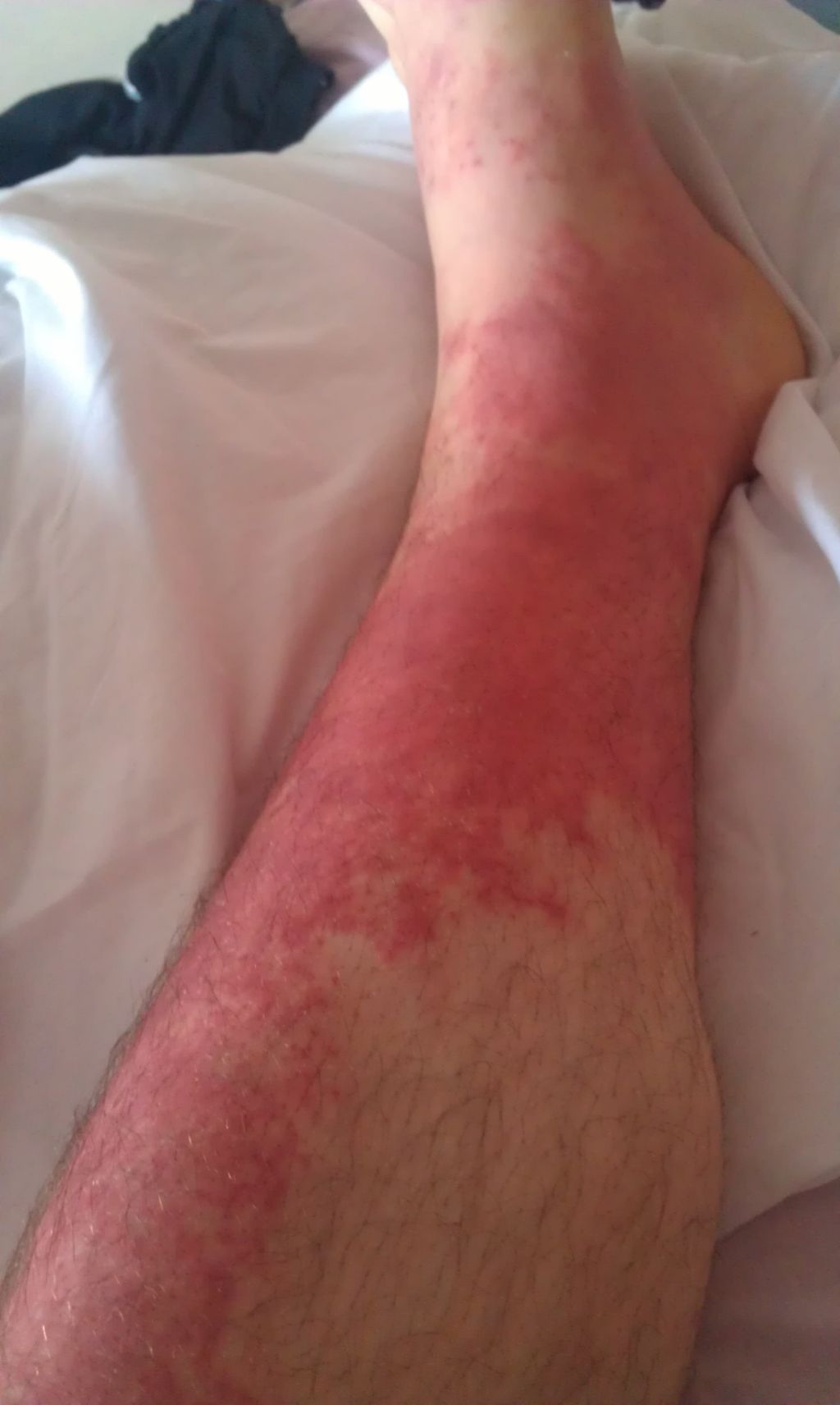 Lower Leg Swelling And Rash - Doctor answers on HealthTap